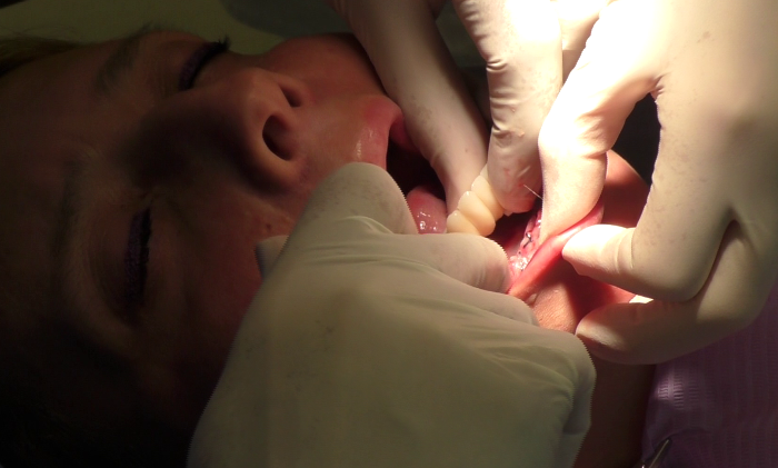 posizionamento protesi dentale fissa circolare senza finta gengiva