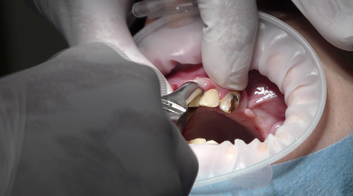 estrazione denti residui